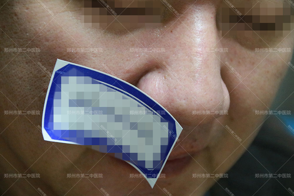 河南中医院疤痕治疗靠谱吗,县医院治疗疤痕