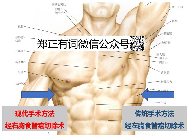 食管癌治疗最新突破,最新食管癌治愈率