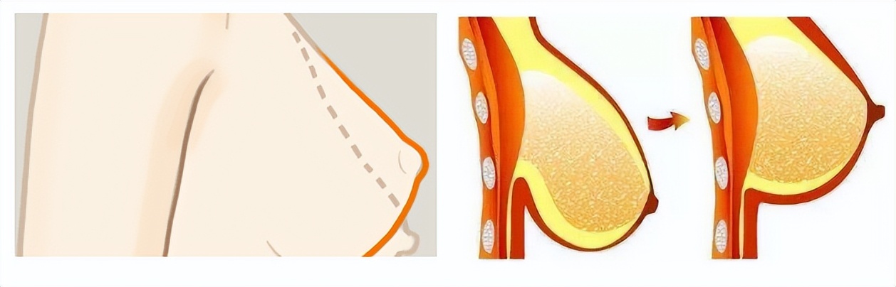 乳房整形美容标准是什么,乳房整形测量设计