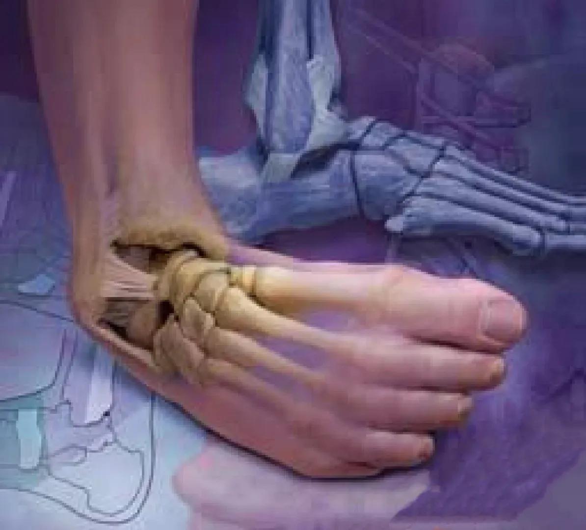 崴脚怎么知道复位了,崴脚别慌4招教你快速康复