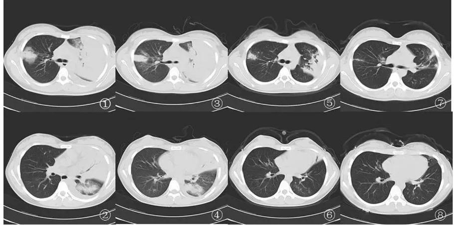 军团菌肺炎吃啥药,军团菌肺炎如何确诊