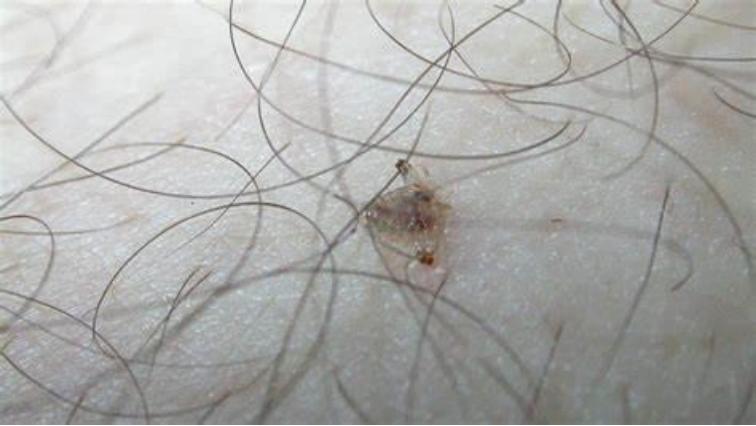 男性大量阴虱和虫卵,男子腹部痒