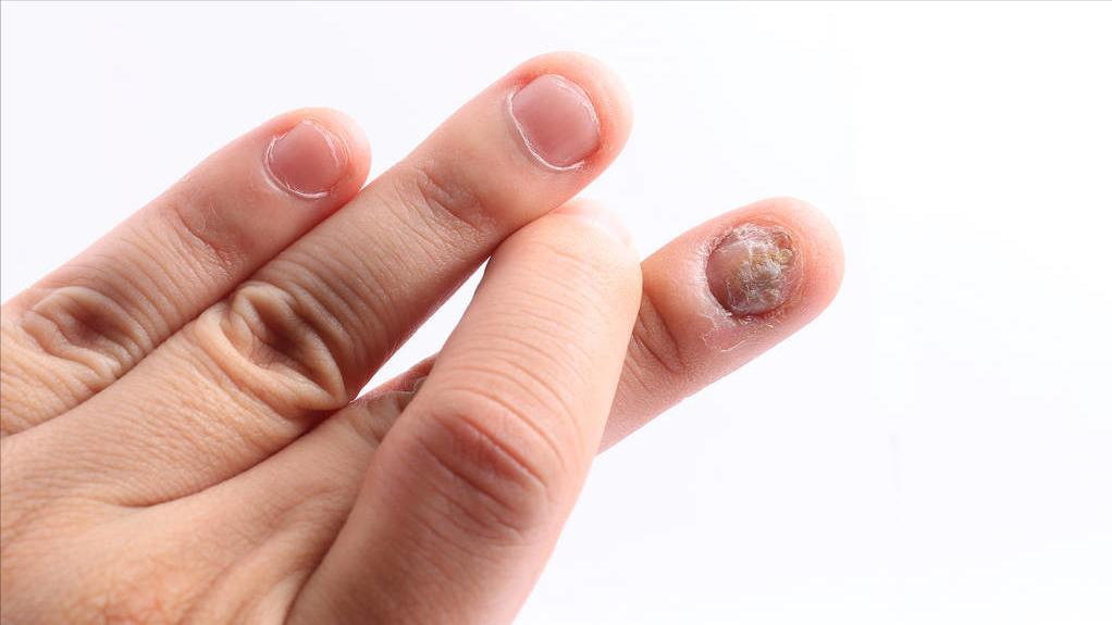 甲沟炎如何快速拔出脚趾甲,脚趾甲老往肉里钻一碰还疼