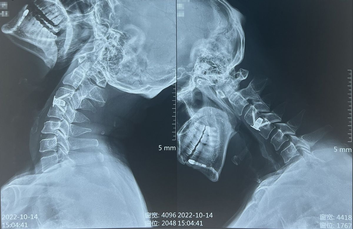 当夜跑爱好者遇上“颈椎病”：颈椎微创手术后多久可以恢复正常？