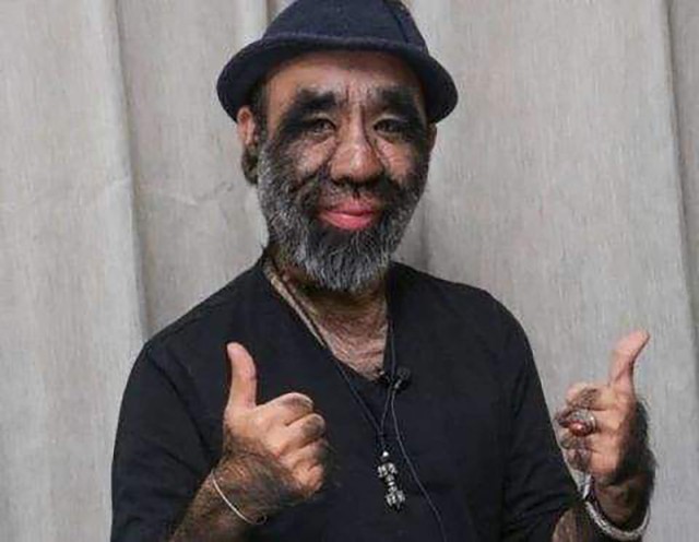 女生因为多毛症被歧视,身患多毛症