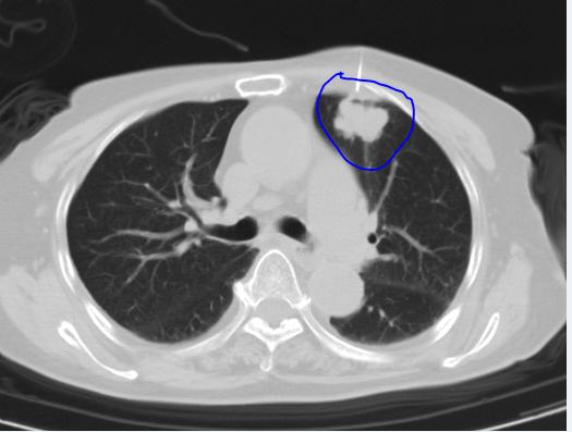 因为疏忽导致病人死亡,因为疏忽犯了无法挽回的错