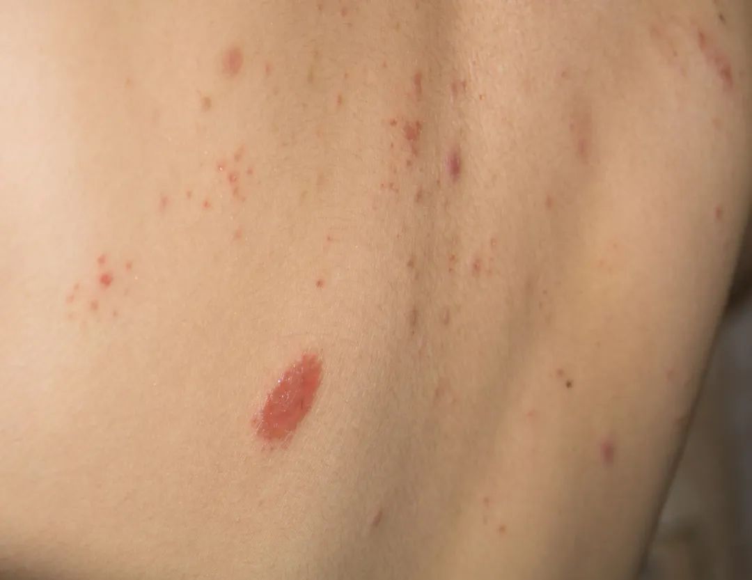 湿疹瘙痒的针灸治疗,针灸治疗湿疹能痊愈吗