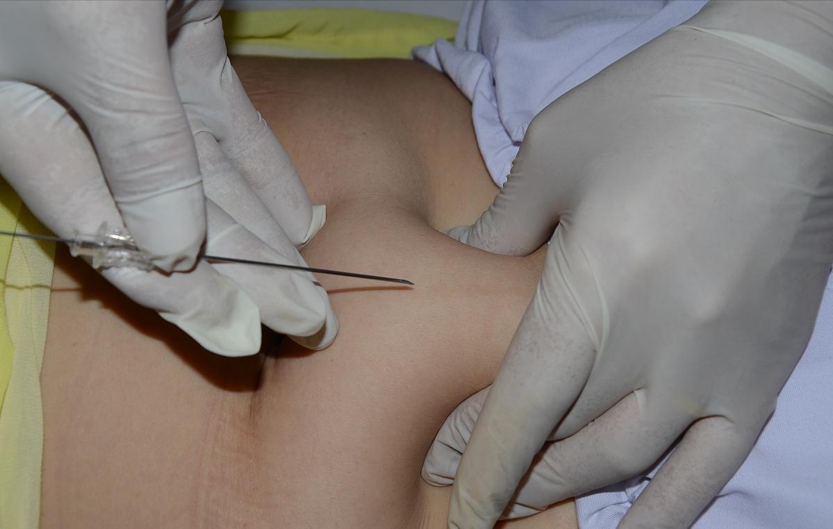 治腰椎间盘突出埋线得几天见效,腰椎间盘突出电针灸治疗的原理