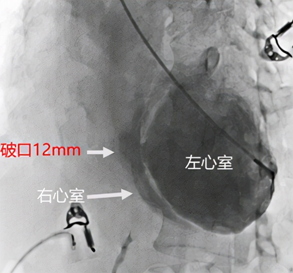 惊险！介入封堵，挽救“破裂”的心