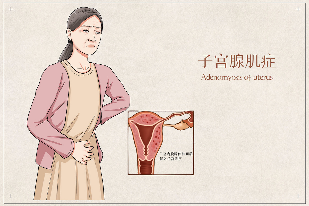 岳氏中医独特专利,治疗子宫腺肌病,用这个方法既能活血又能止痛