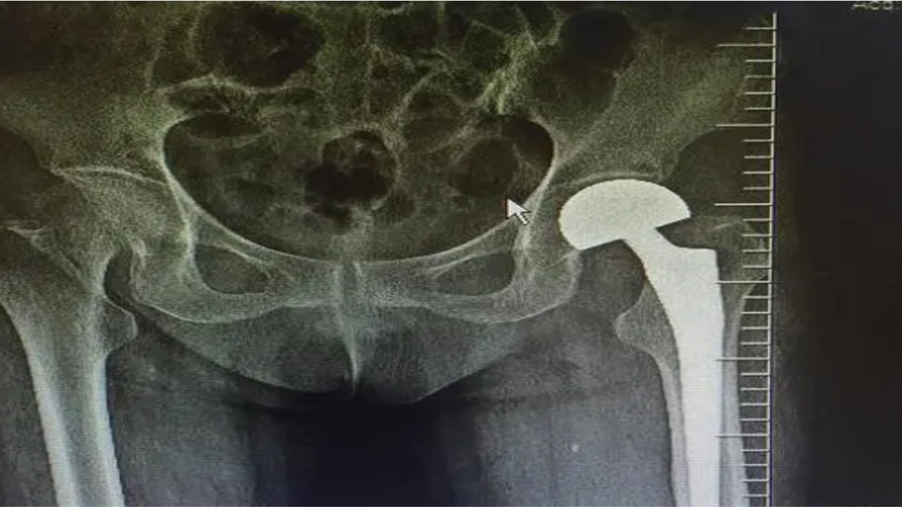 老年人摔了一跤筋摔伤了,老人腿骨摔骨折了吃啥补好