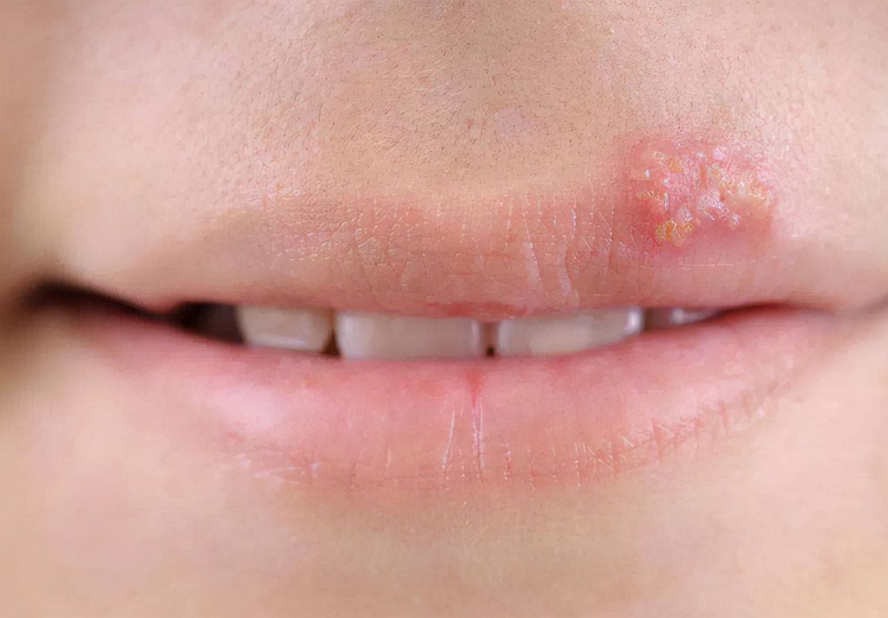 嘴巴边缘长水泡是上火了吗,嘴唇上火长水泡最简单的解决方法