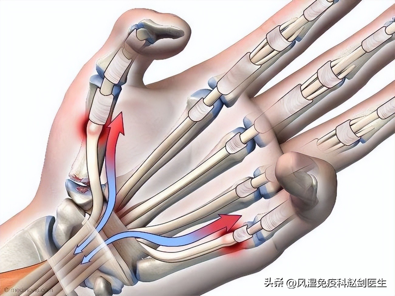 钓鱼造成手腕腱鞘炎,钓鱼导致手腕腱鞘炎