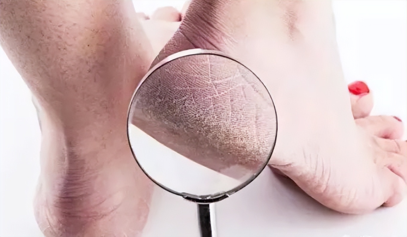 维生素b12缺乏脚底会脱皮吗 (脚底脱皮缺乏哪种维生素)