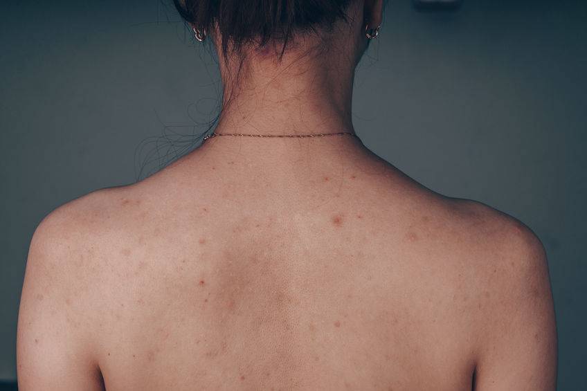 头皮毛囊炎用什么药清洗可以缓解,毛囊炎凸起硬疙瘩怎么缓解