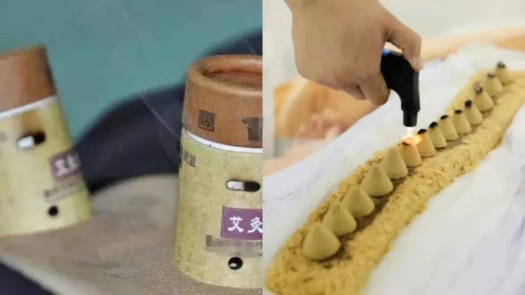 冬病夏治的针灸要连着做三天吗,冬病夏治正当时三伏贴即将开始