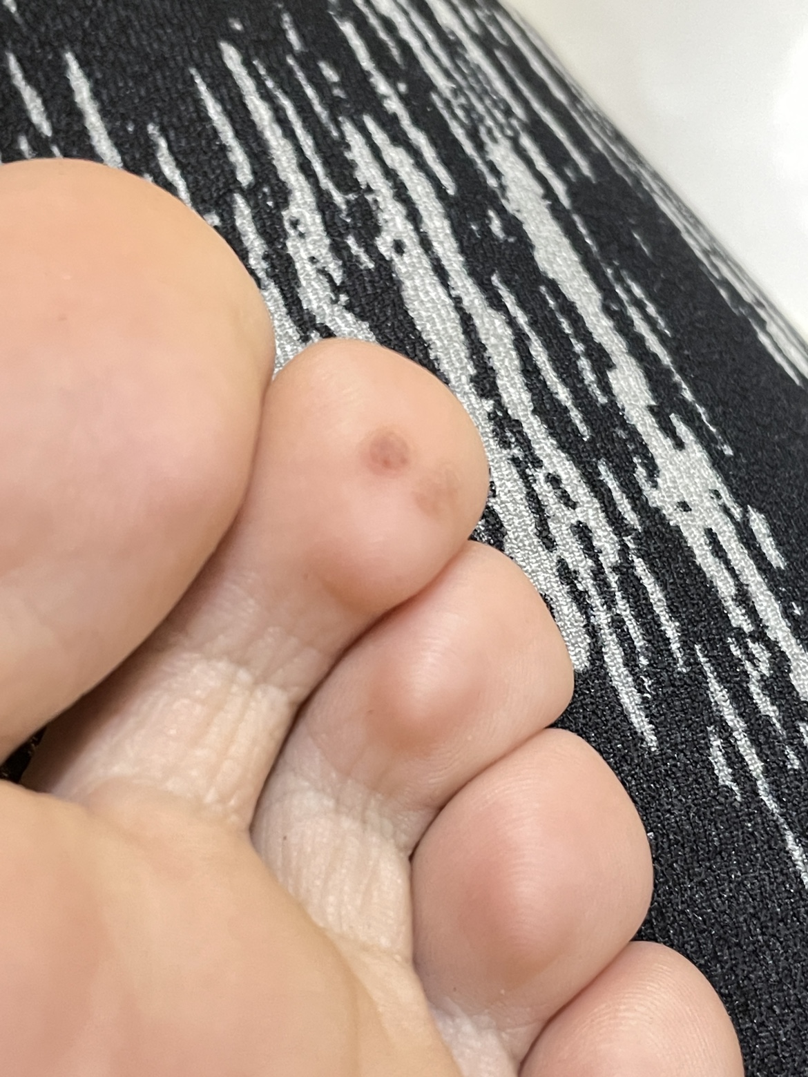 如何辨别鸡眼和跖疣区别,如何辨别鸡眼疣