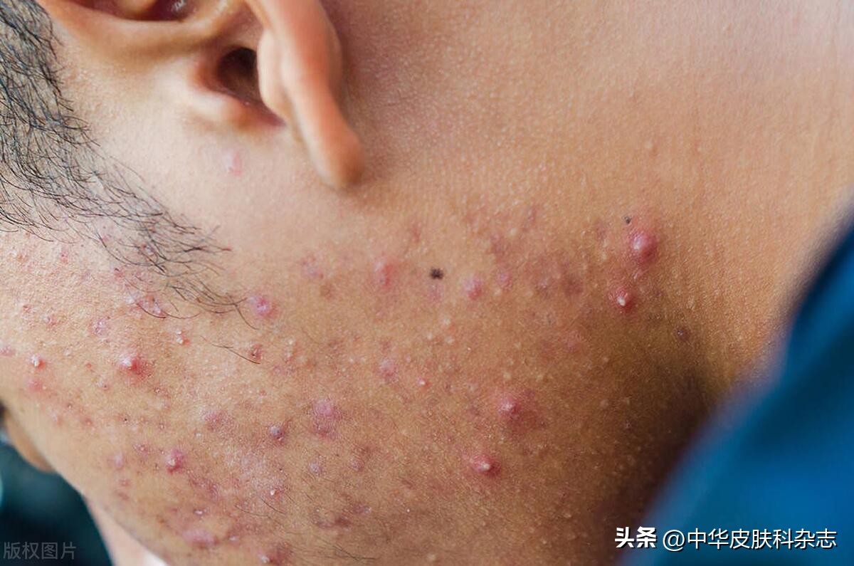 反常性痤疮用什么药,反常痤疮
