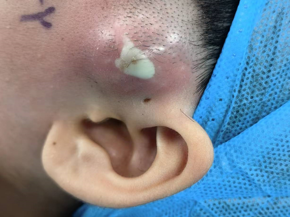 耳前瘘管感染怎么食疗,耳前瘘管感染引流一般几天能好