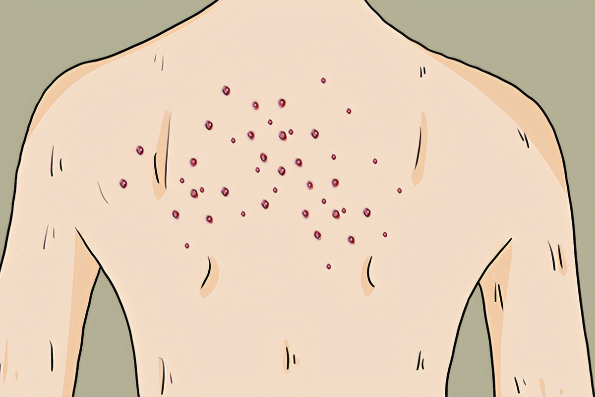 起过水痘以后会得带状疱疹吗,得了水痘还得带状疱疹