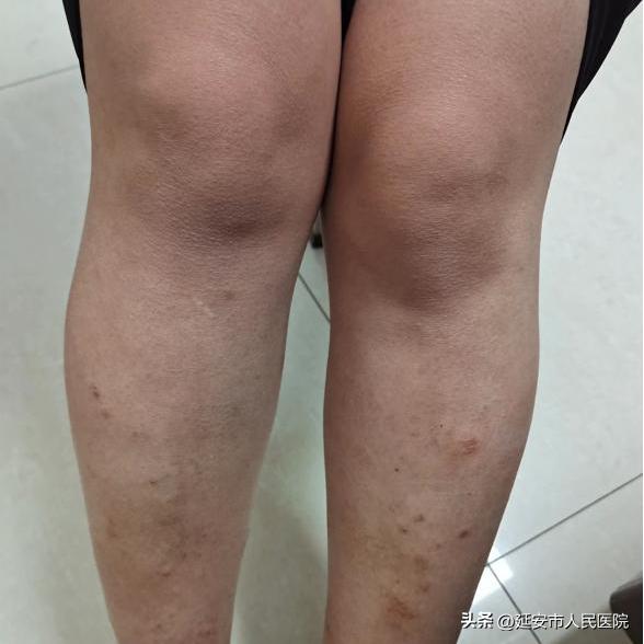 感染新冠皮肤能变好吗,新冠病毒可以通过皮肤感染吗