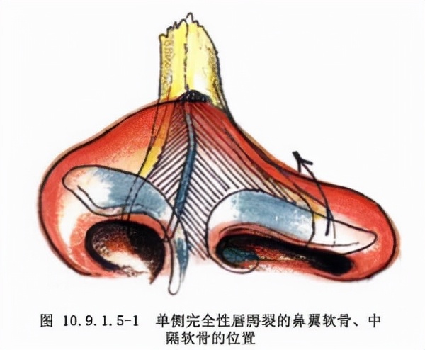 鼻子畸形堵住了怎么治？唇裂继发鼻畸形的患者可以这样做
