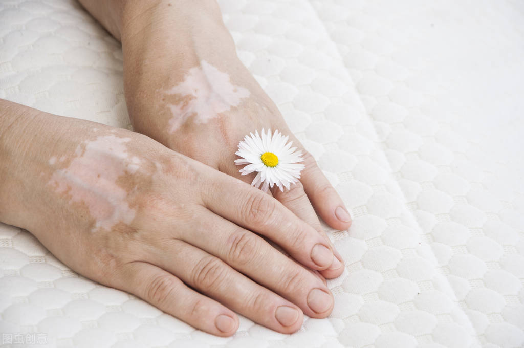 身体出现小白点是什么病,白癜风的位置上慢慢出现小黑点