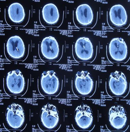脑外伤后硬膜下积液颅骨修补,颅骨修复手术失败导致脑积水