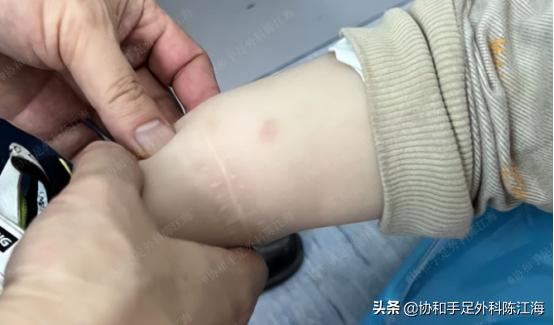 宝宝36周出生要紧吗,宝宝出生37天脐带没有脱落