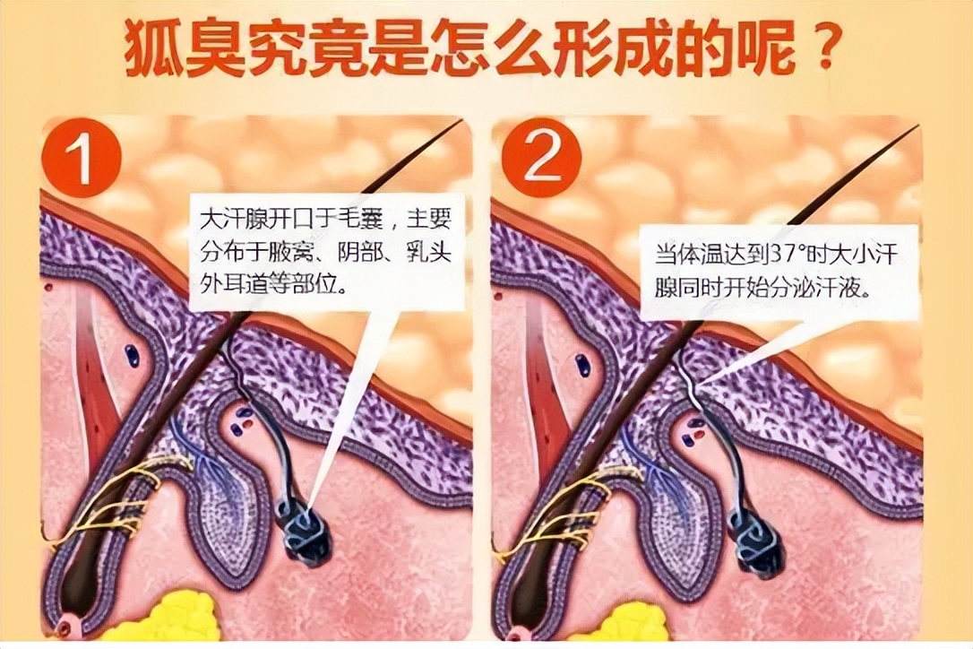 得了狐臭怎么办,狐臭手术后需要注意什么