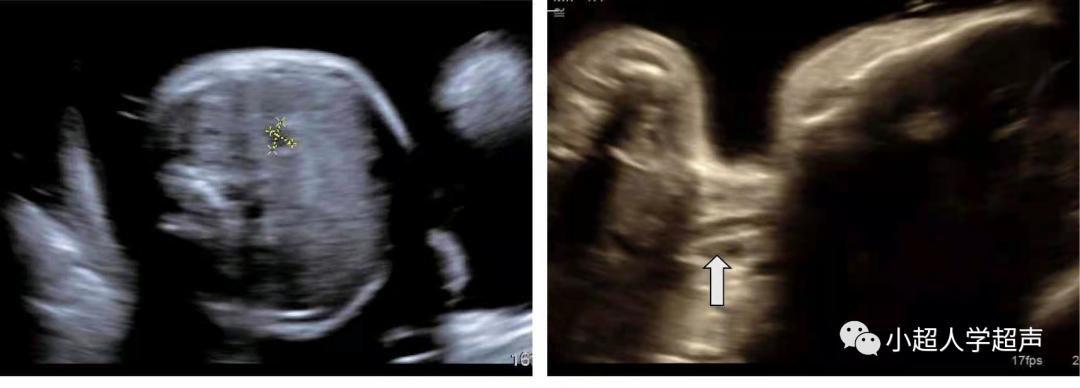 食道闭锁超声表现,食管闭锁一型手术过程