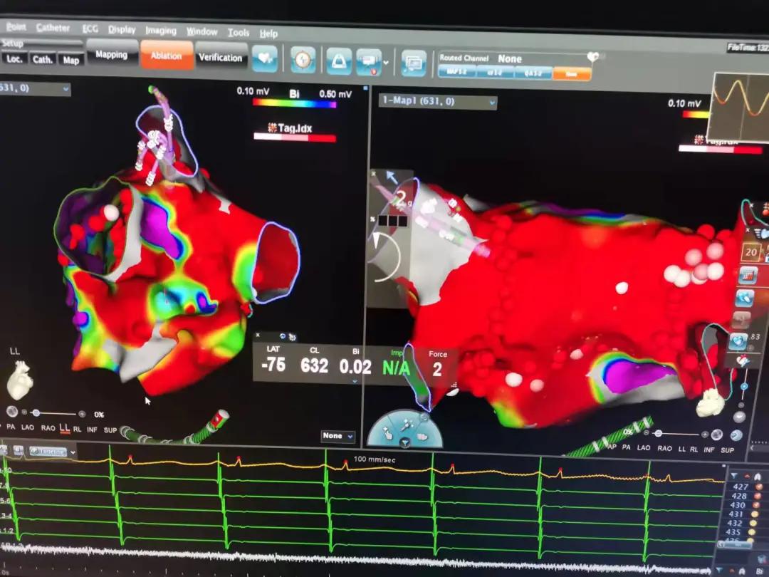 房颤怎么治疗讲座视频,房颤怎么治疗演示图