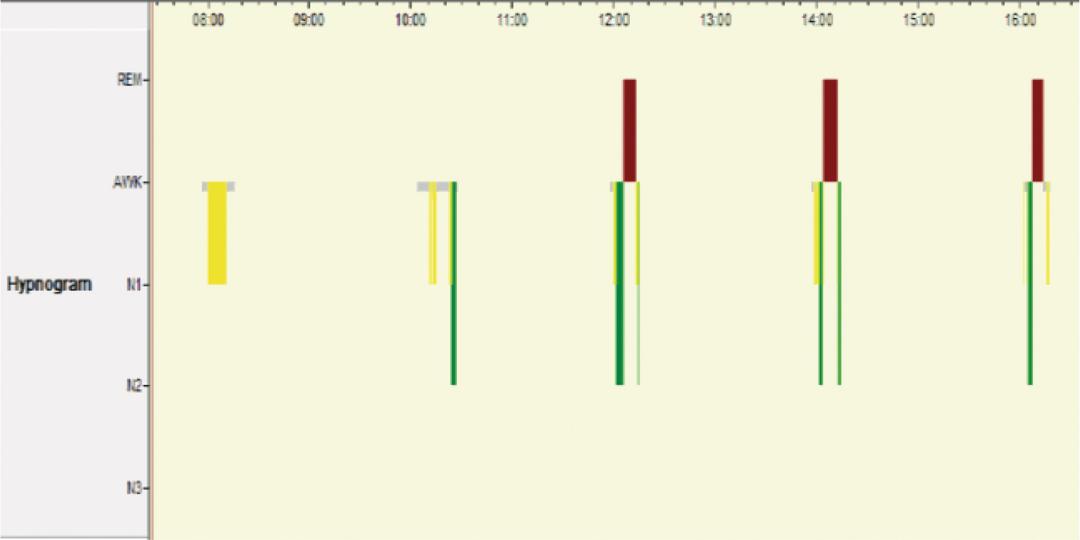 白天嗜睡昏昏欲睡什么症状,白天嗜睡是什么病的前兆