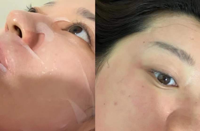 收缩毛孔激光点阵真实效果,毛孔缩小最有效的办法用点阵激光