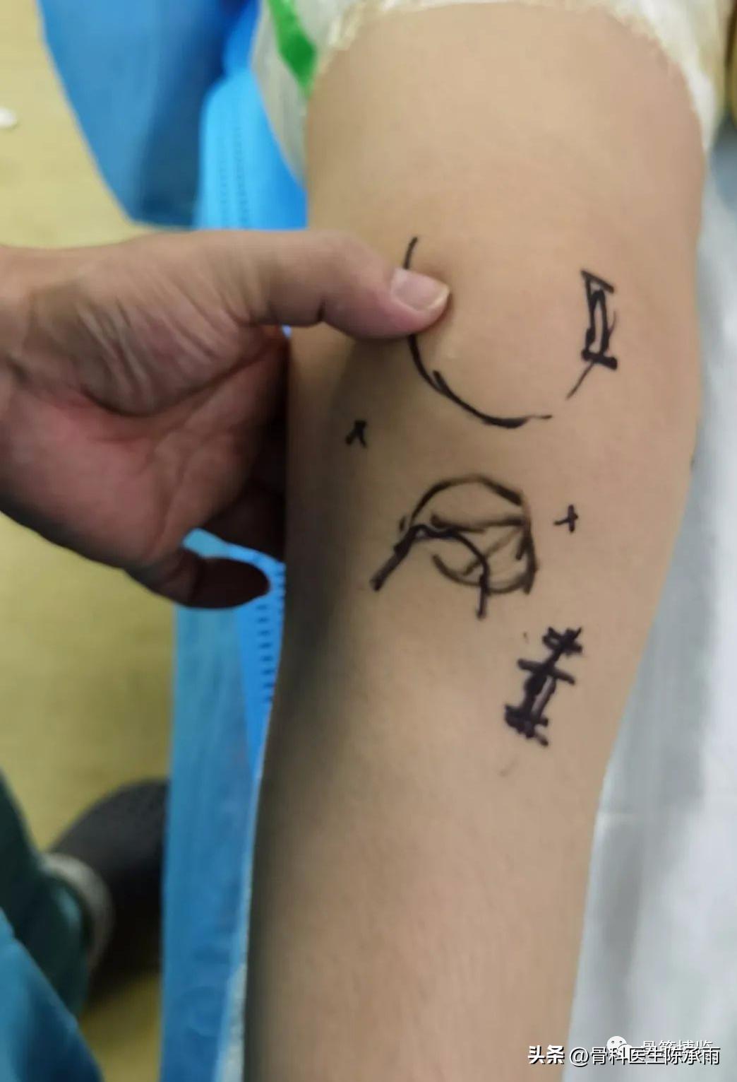 髌骨脱位保守康复训练具体步骤,髌骨脱位重建手术全过程