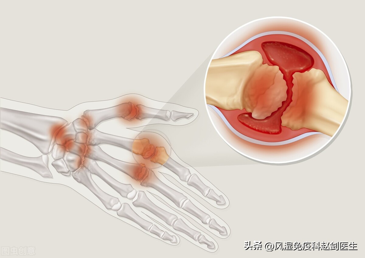 类风湿发现得早可以控制吗,怎么才能知道类风湿控制住了