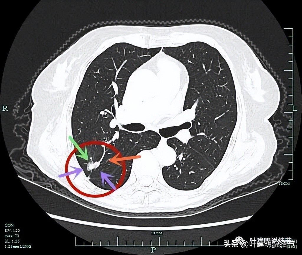 79岁肺癌早期手术风险,75岁早期浸润性肺癌还要治疗吗
