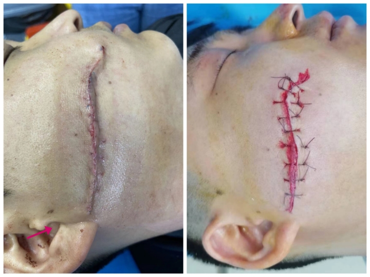 点阵激光后的伤口要几天愈合,点阵激光对去除疤痕效果明显吗