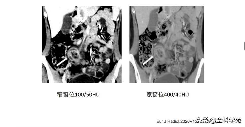 阑尾炎的讲解,关于阑尾炎的讨论总结