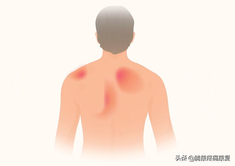 颈椎病引起肩胛骨疼痛怎么缓解,右肩胛骨下方疼痛如何运动缓解
