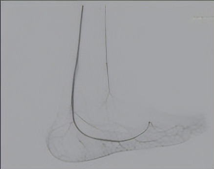 脚底板血管瘤介入治疗,脚底弥漫海绵状血管瘤