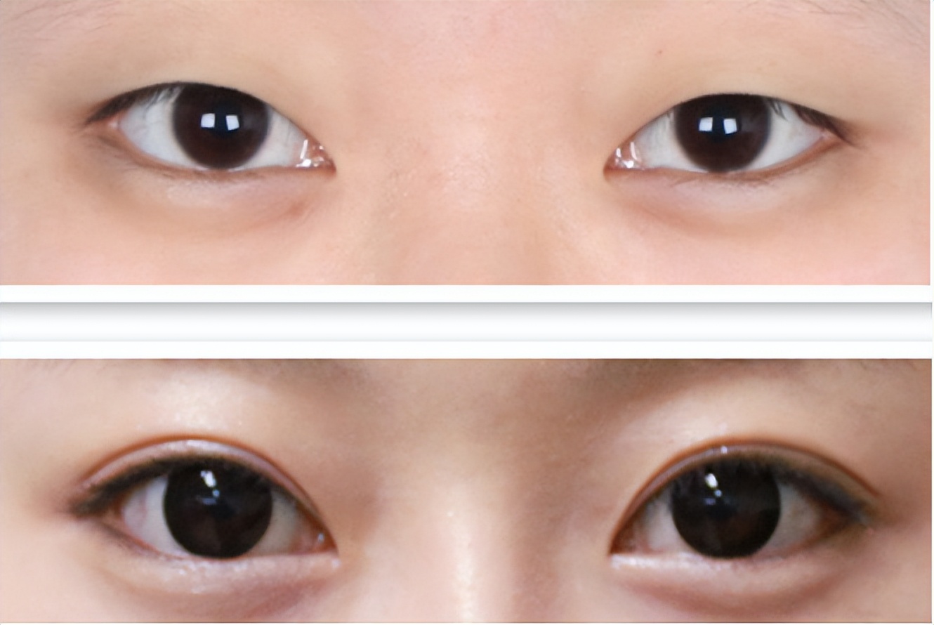 河南两兄弟割双眼皮被劝退,郑州割双眼皮失败男子