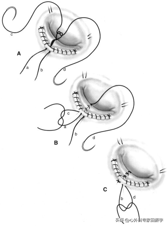 二尖瓣成形术,二尖瓣成形术后需要静养多久