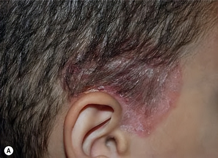 头皮有很多红疙瘩是脂溢性皮炎吗,脂溢性皮炎头皮是由什么引起的