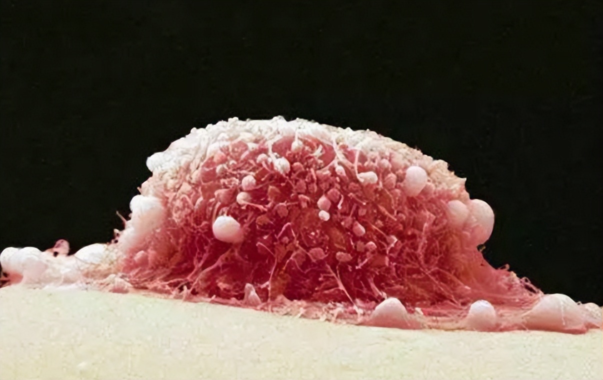 “外阴癌”都是拖出来的？医生：出现3种异常信号，要引起注意