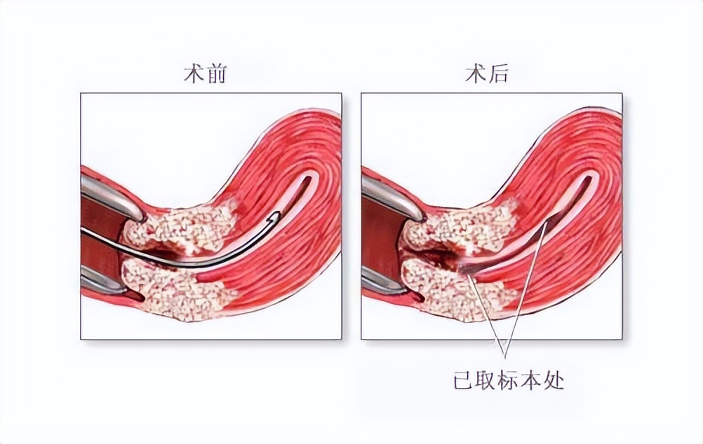 阴道炎症状会变成癌症吗,阴道炎症状检查时一碰就出血