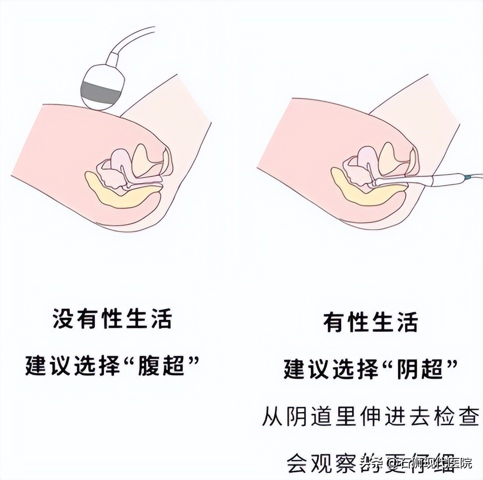 48岁的女人妇科体检应该做哪几项,妇科检查怎么查