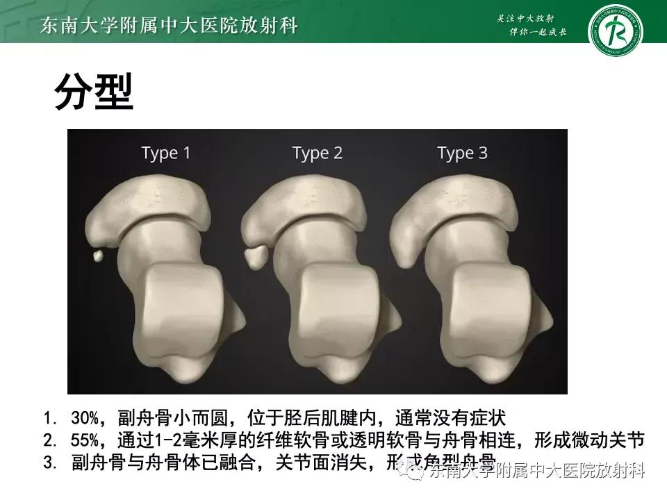 好文分享-《肌骨系统疾病——副舟骨综合征》