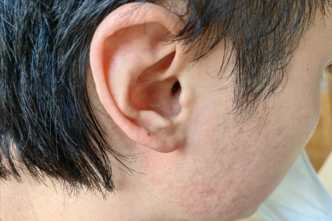 面部皮炎是炎症吗,脂溢性皮炎面部痒