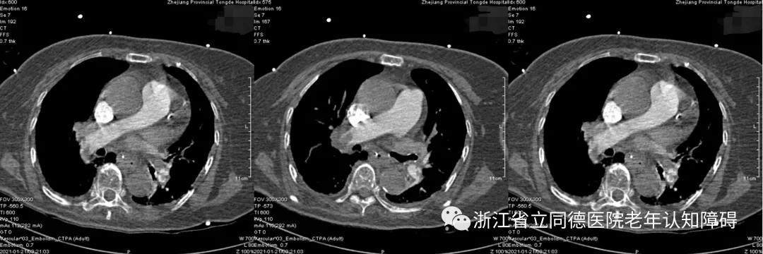 老年痴呆幻听幻觉,老年痴呆幻视幻听吃什么药